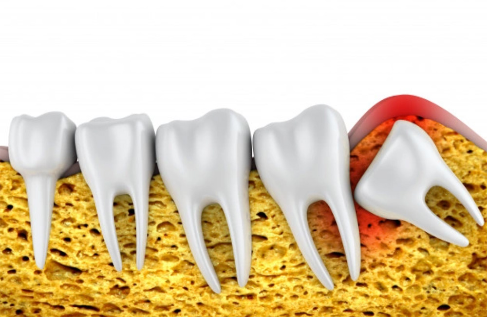 Periodontal & Gum Surgeries | Garg Dental Care & Implant Center | Dental Clinic in Sonipat