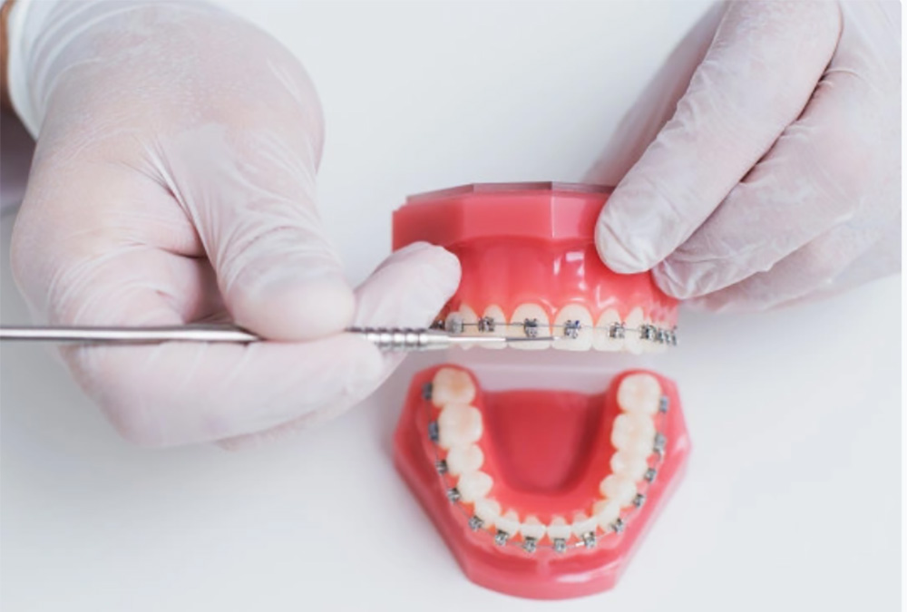 Braces for Teeth Alignment | Garg Dental Clinic Sonipat | Dental Clinic in Sonipat