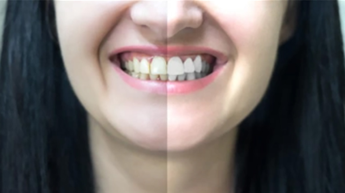 Tooth Colored Restorations | Garg Dental Care & Implant Center | Dental Clinic in Sonipat